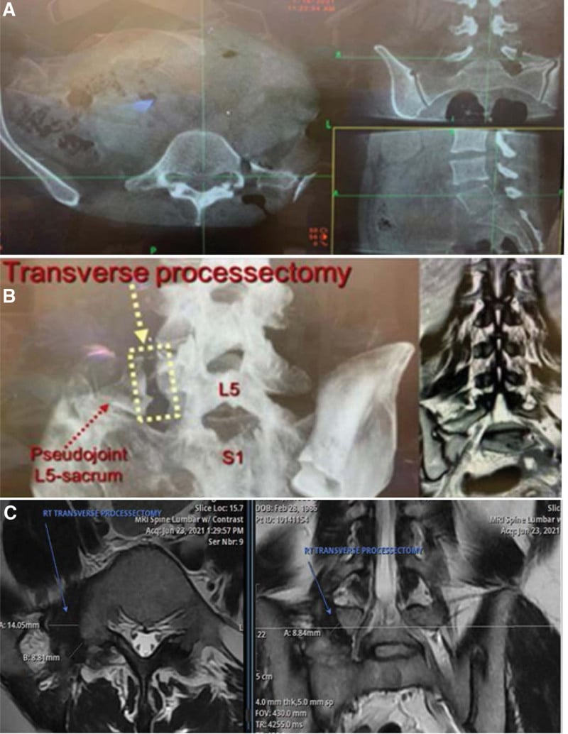 O-arm 3D confirmation of transverse processectomy with postoperative MRI