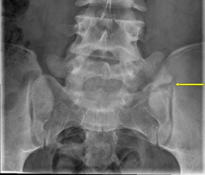 Preoperative AP radiograph with prominent L5 transverse processes, the left appearing to articulate with the sacrum
