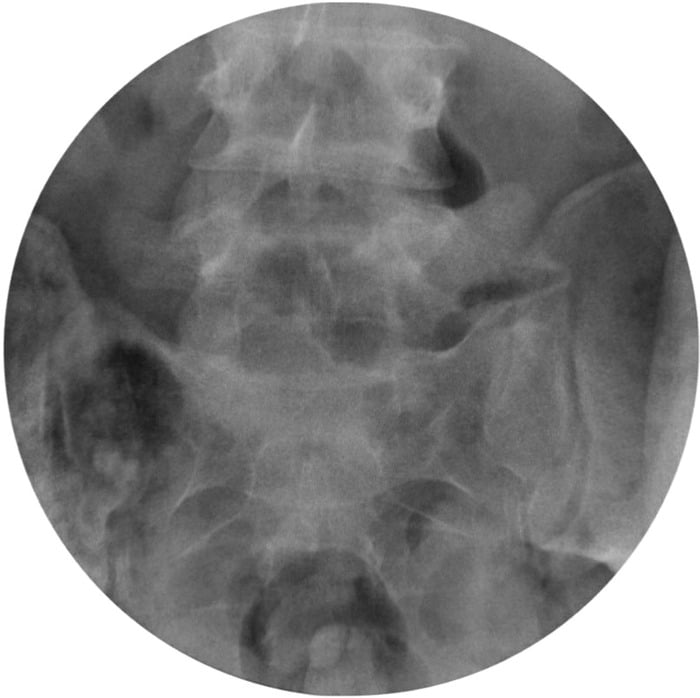 Intraoperative AP radiograph after excision of the left L5-sacral transitional articulation