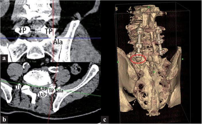 Preoperative coronal, axial and 3D CT of extraforaminal L5 entrapment between the transverse process and sacral ala