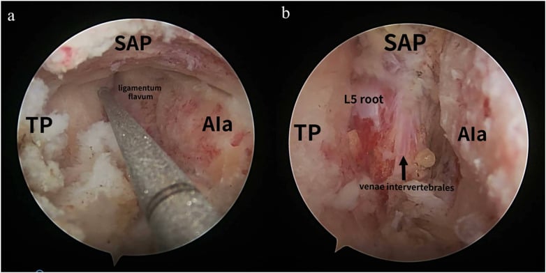 Endoscopic views of extraforaminal L5 decompression with the transverse process, superior articular process, sacral ala and L5 root labelled