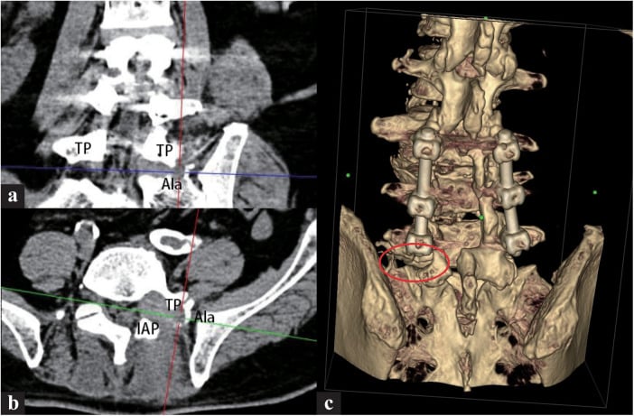 Postoperative coronal, axial and 3D CT after extraforaminal L5 decompression
