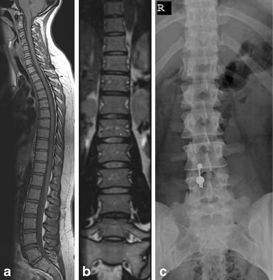 Sagittal whole-spine MRI, coronal MRI reformat and AP lumbar radiograph identifying a sacralised L5 by counting from the top