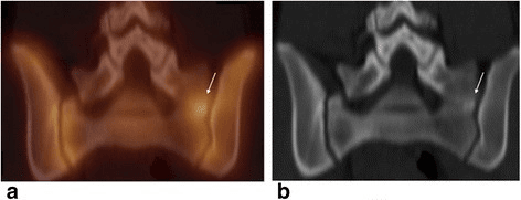 Two-panel SPECT and CT of the lumbosacral junction showing a symptomatic transitional articulation on the left, arrowed on both panels