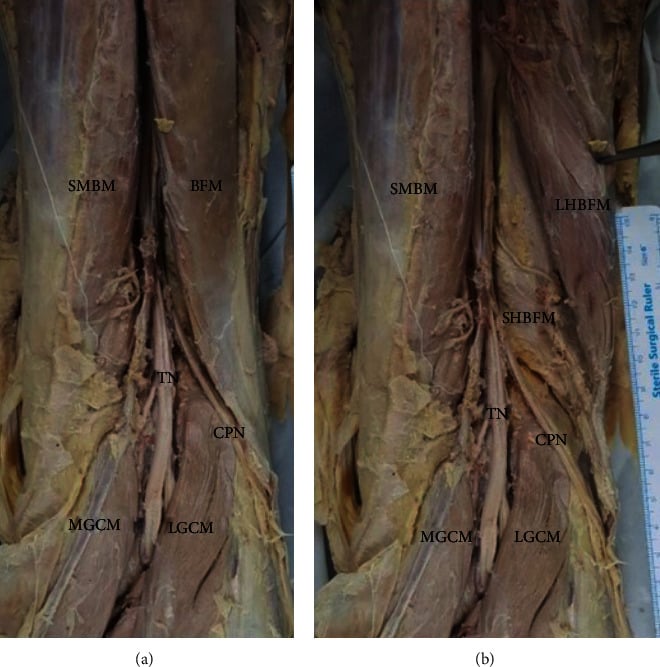 Posterior cadaveric knee dissection showing the common peroneal nerve beside the biceps femoris and superficial to the lateral gastrocnemius
