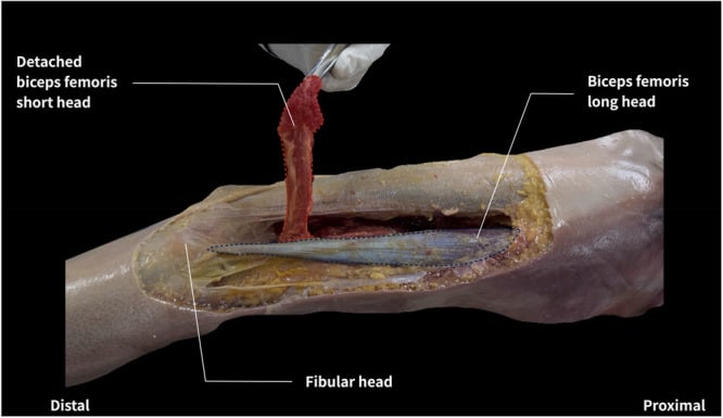Cadaveric lateral thigh dissection showing the biceps femoris short head detached from the linea-aspera and lateral intermuscular-septum origin