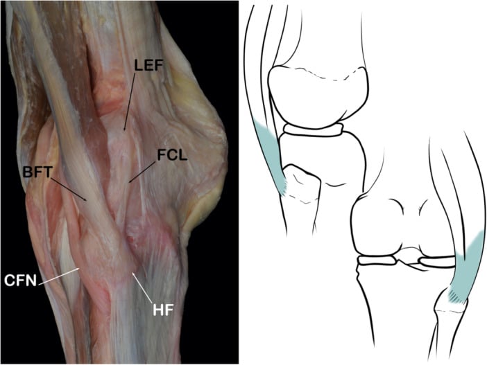 Cadaveric dissection and schematic of the lateral knee showing the biceps femoris tendon, fibular collateral ligament, fibular head and common fibular nerve