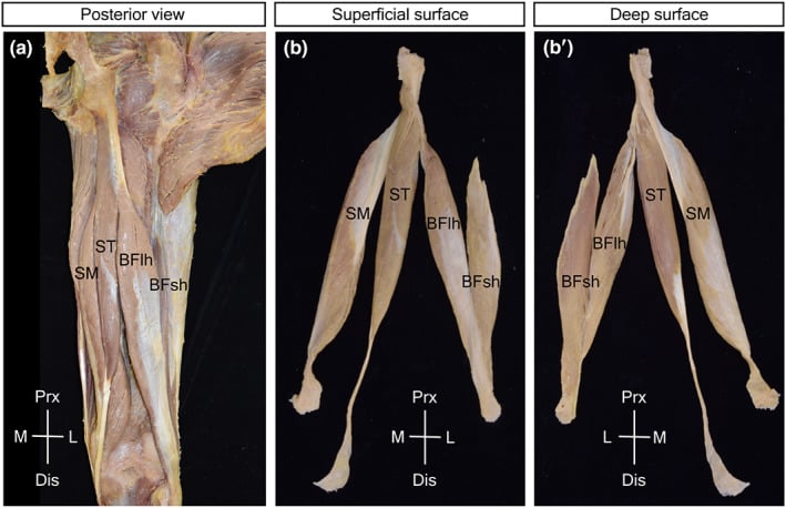 Posterior cadaveric thigh dissection and isolated hamstrings showing the biceps femoris short and long heads in situ and from superficial and deep surfaces