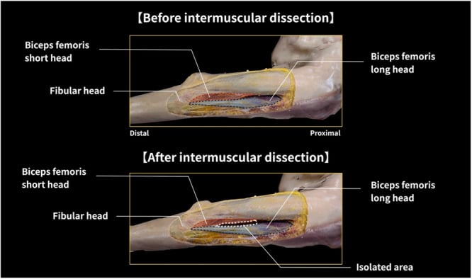 Cadaveric sequence before and after separating the intermuscular connection between the biceps femoris long and short heads