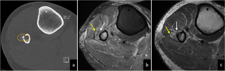 CT and MRI series showing common peroneal nerve entrapment and denervation changes after a proximal fibular fracture