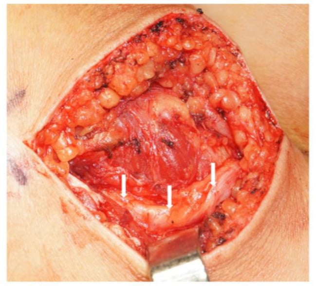 Operative lateral fibular-head exposure showing the common peroneal nerve after distal release