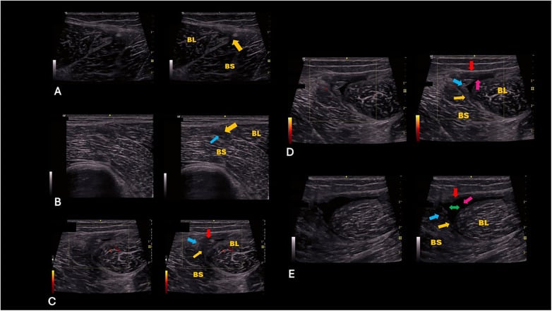 Ultrasound classification panels of biceps femoris T-junction injuries showing progressive disruption between the long and short heads