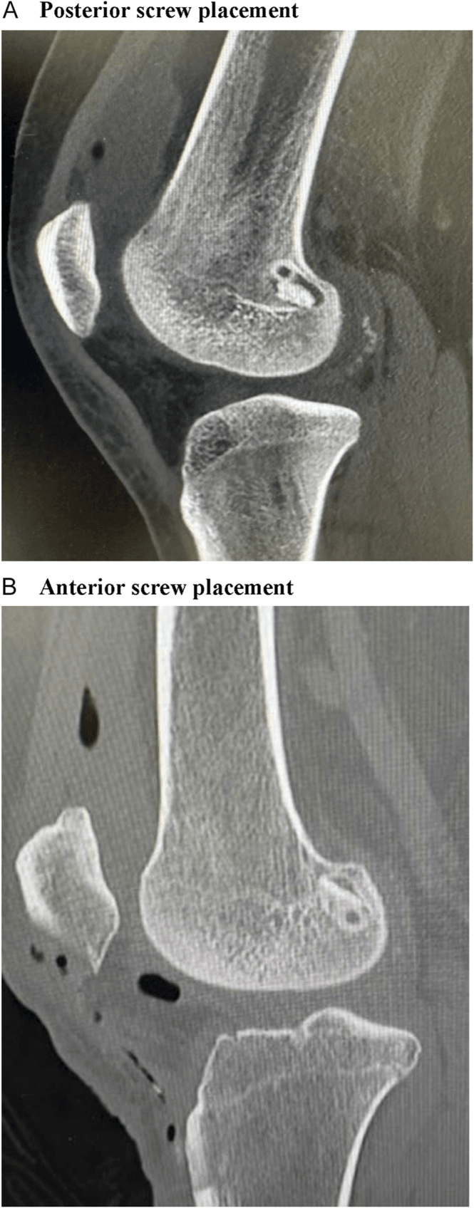 Sagittal CT showing anterior and posterior absorbable interference screw positions
