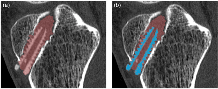 CT segmentation of bone tunnel and residual biocomposite screw