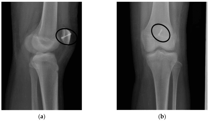 Lateral and AP knee radiographs with bioabsorbable screw fixation circled