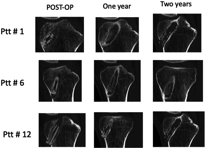 Post-operative one-year and two-year CT examples of biocomposite interference screw resorption