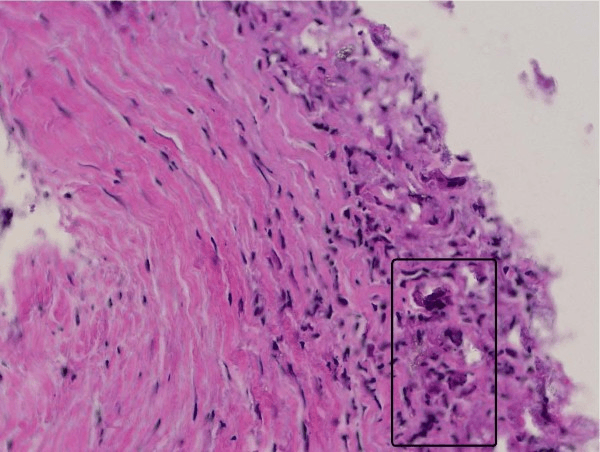 Histology showing foreign-body reaction to degraded interference screw material