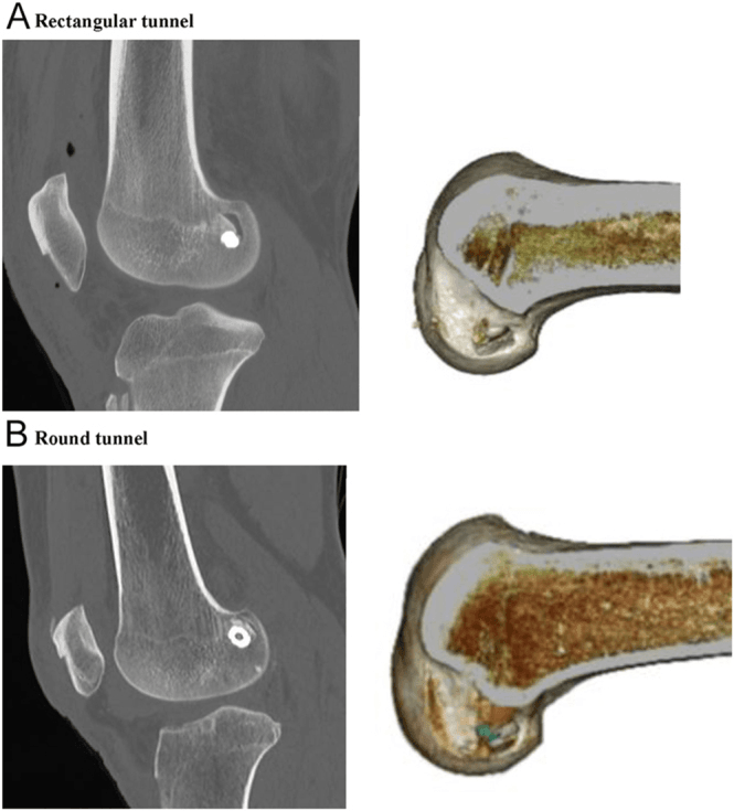 CT comparison of rectangular and round femoral bone tunnels around interference fixation