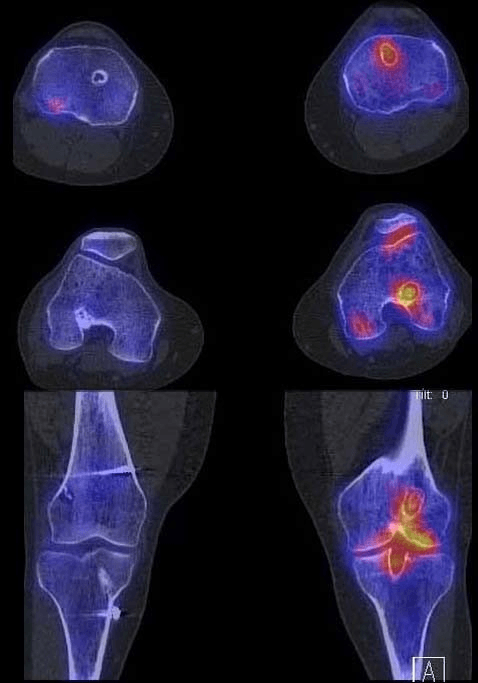 SPECT CT showing asymmetric tracer uptake around ACL bone tunnels