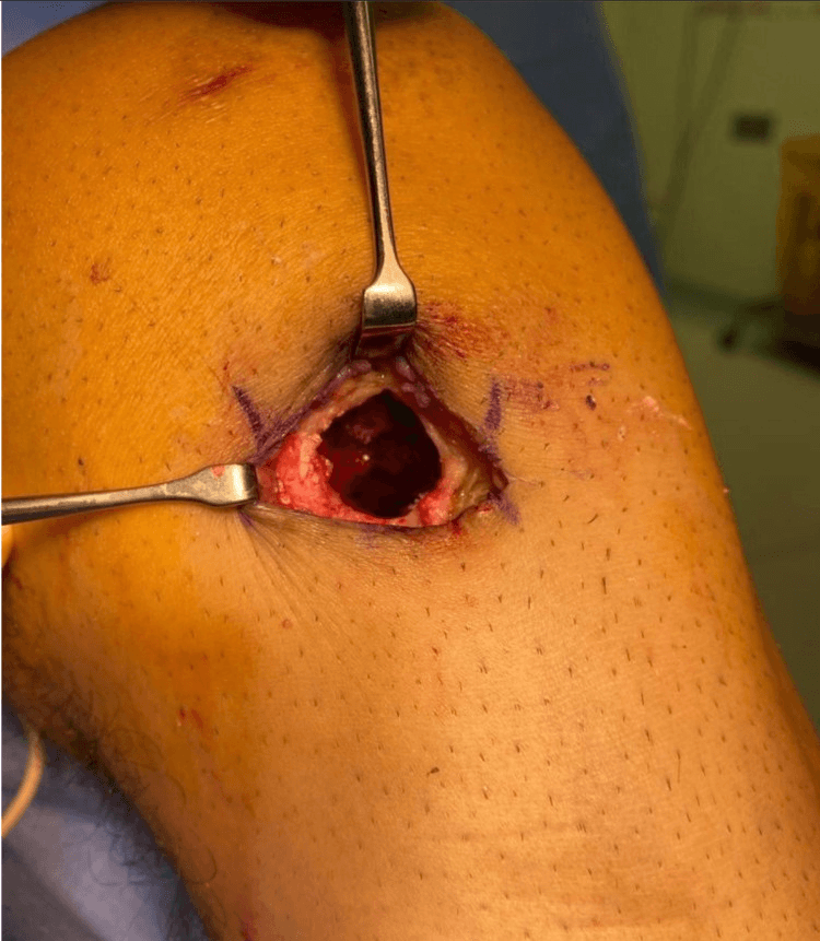 Operative pretibial cyst cavity after bioabsorbable ACL interference screw fixation