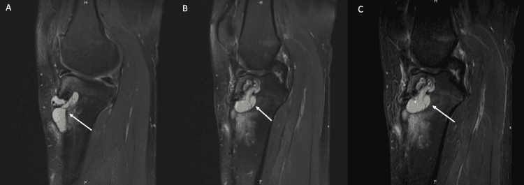 Sagittal MRI showing pretibial cyst communication with the tibial tunnel