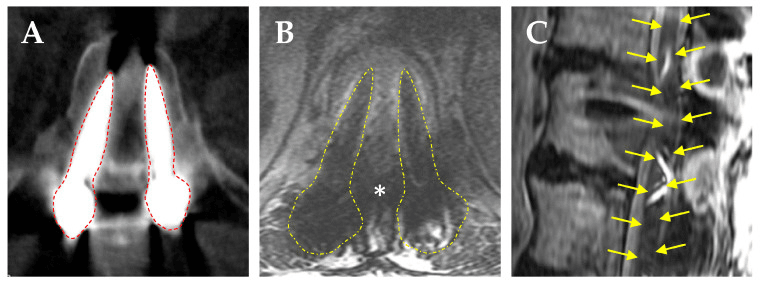CT and MRI artifact caused by titanium screws