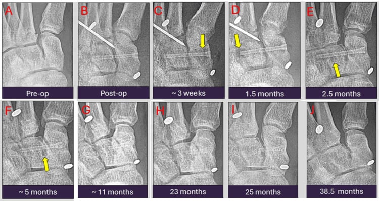 Serial radiographs of a magnesium compression screw showing normal degradation over time