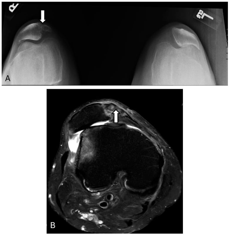 Bipartite patella with marrow oedema and shallow trochlea