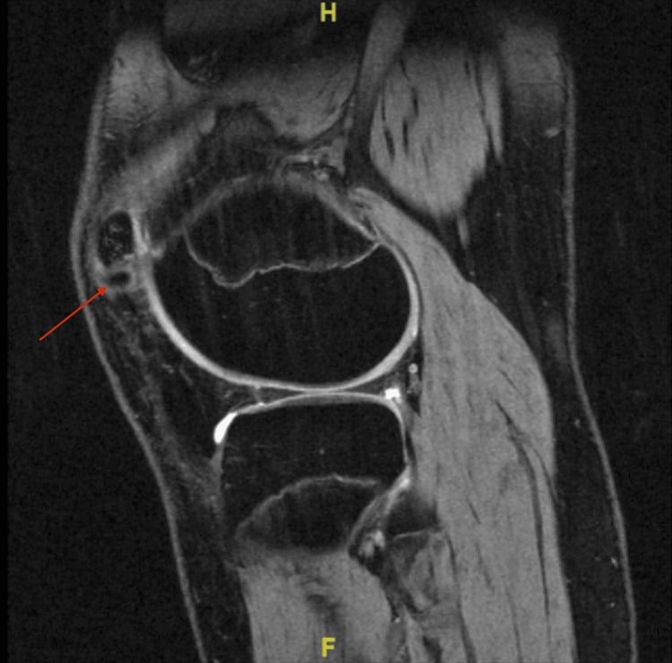 MRI showing a symptomatic superolateral bipartite fragment