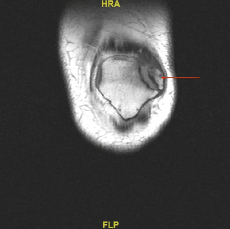 MRI showing quadriceps attachment to a superolateral bipartite fragment