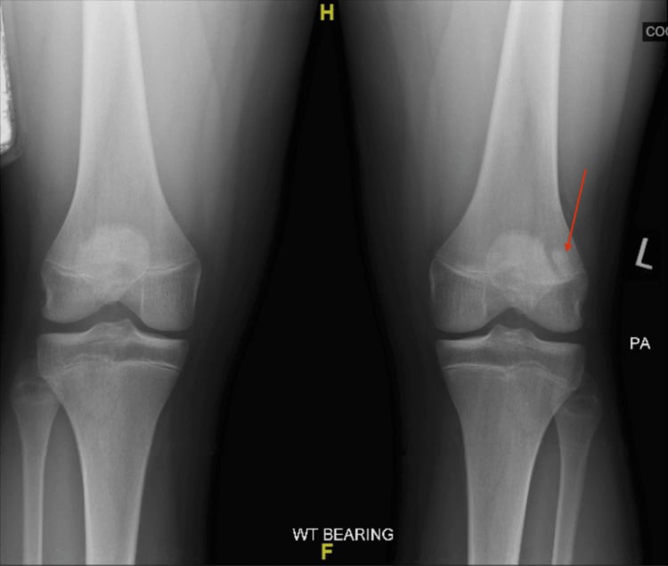 Weight-bearing bilateral radiograph showing fragmented bipartite patella