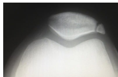 Bipartite patella after direct trauma with persistent anterior knee pain