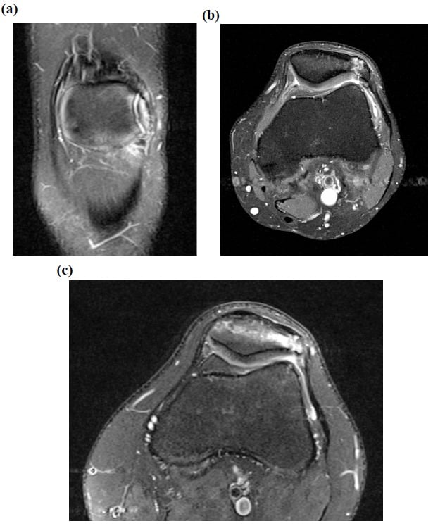 MRI showing disrupted painful bipartite synchondrosis and cartilage fissure