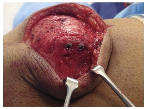 Open reduction and two-screw fixation of a painful bipartite patella