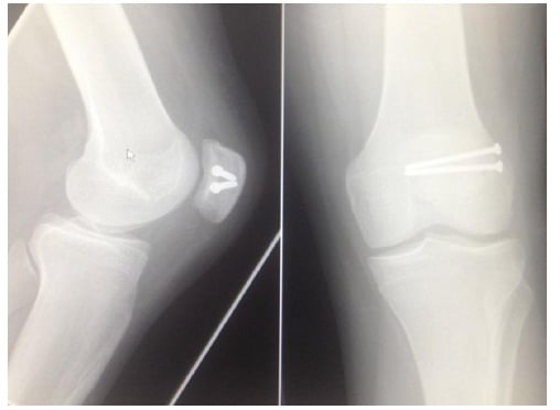 Six-week radiographs after bipartite patella fixation