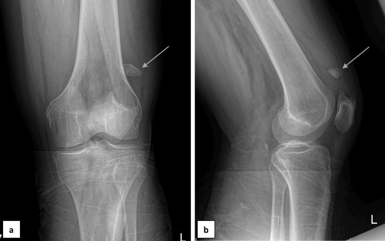 Radiographs of traumatic separation of a type-three bipartite patella