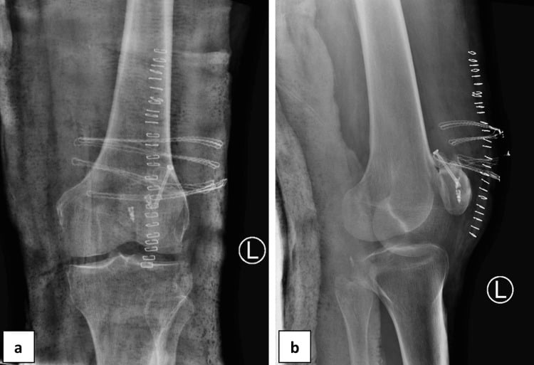 Screw and suture-anchor fixation of a separated bipartite fragment