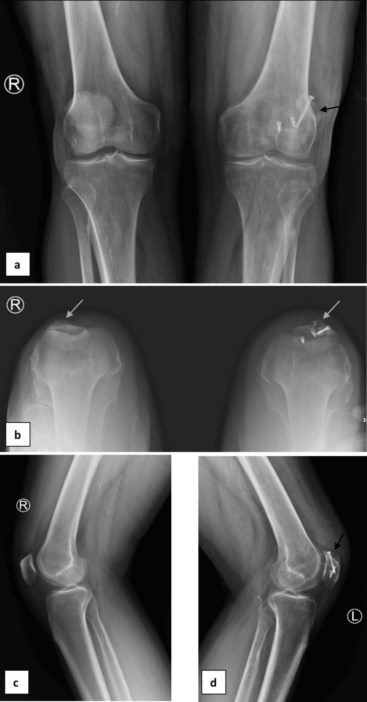 Long-term bilateral follow-up after bipartite patella fixation