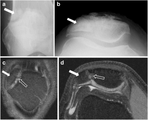 AP and tangential radiographs with CT and MRI showing superolateral bipartite patella in two incidental cases