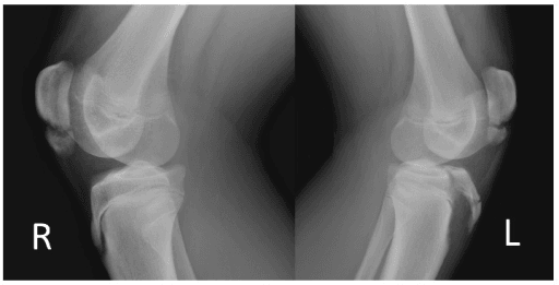 Lateral radiographs of both knees showing inferior pole accessory ossification in a 14-year-old athlete