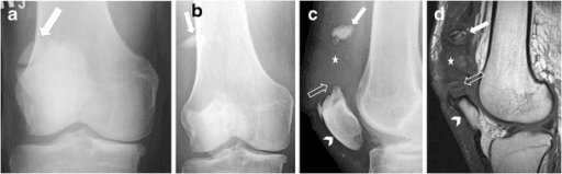 AP, lateral, CT and MRI of a superolateral bipartite patella with corticated synchondrosis in a 70-year-old