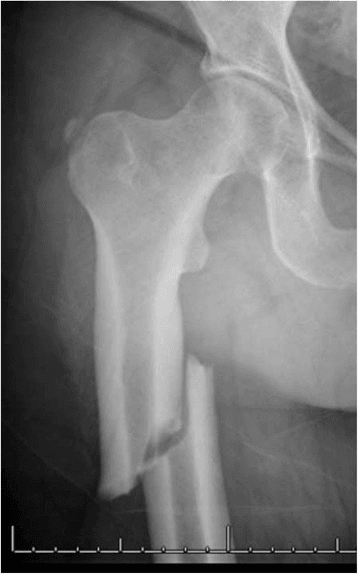 AP radiograph of the proximal femur showing a complete subtrochanteric femoral fracture with a medial fragment