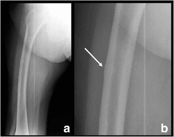 Two-panel radiograph of an incomplete atypical femoral fracture with an arrow indicating lateral cortical beaking