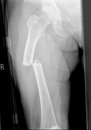 AP radiograph of the right hip showing a complete displaced subtrochanteric femoral fracture