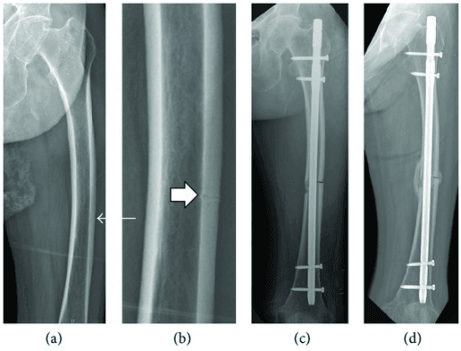 Anteroposterior femoral radiograph showing bowing with a transverse lateral cortical radiolucent line