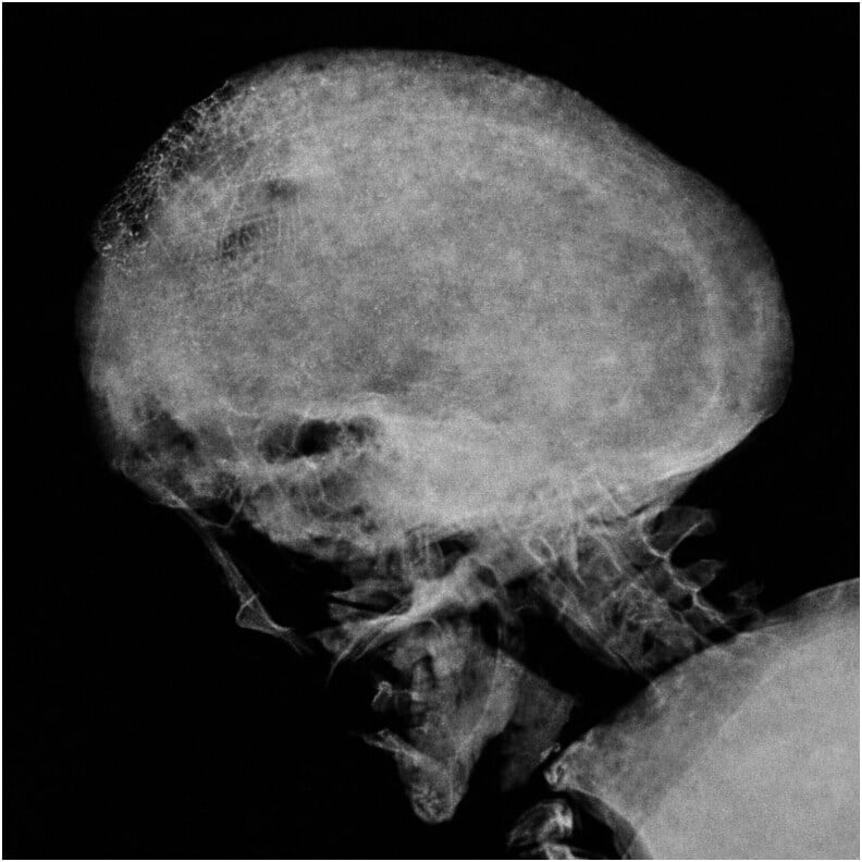 Lateral skull radiograph showing the cotton wool appearance of Paget's disease