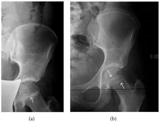 Hip radiographs showing dense metaphyseal lines after paediatric bisphosphonate treatment