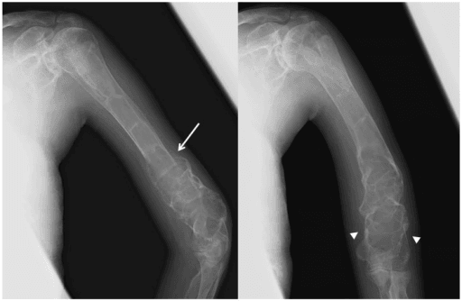 Radiographs of the humerus showing progressive cortical thickening after zoledronate