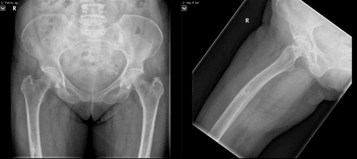 Radiograph showing an incomplete atypical femoral fracture with lateral cortical thickening