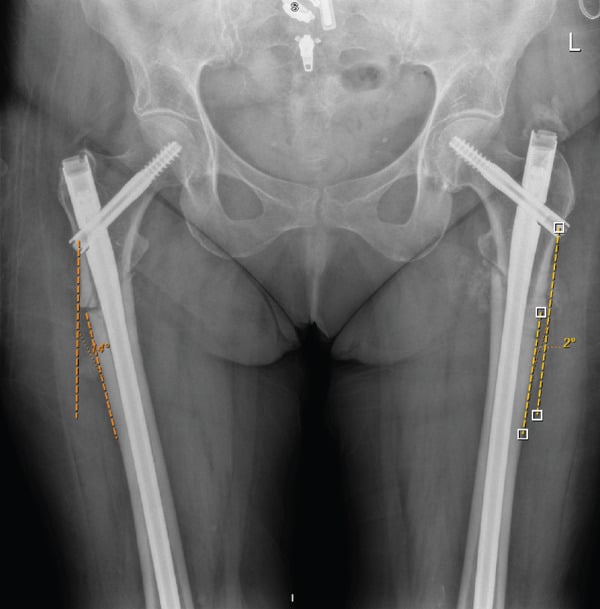 Postoperative radiograph showing bilateral cephalomedullary nailing of atypical femoral fractures